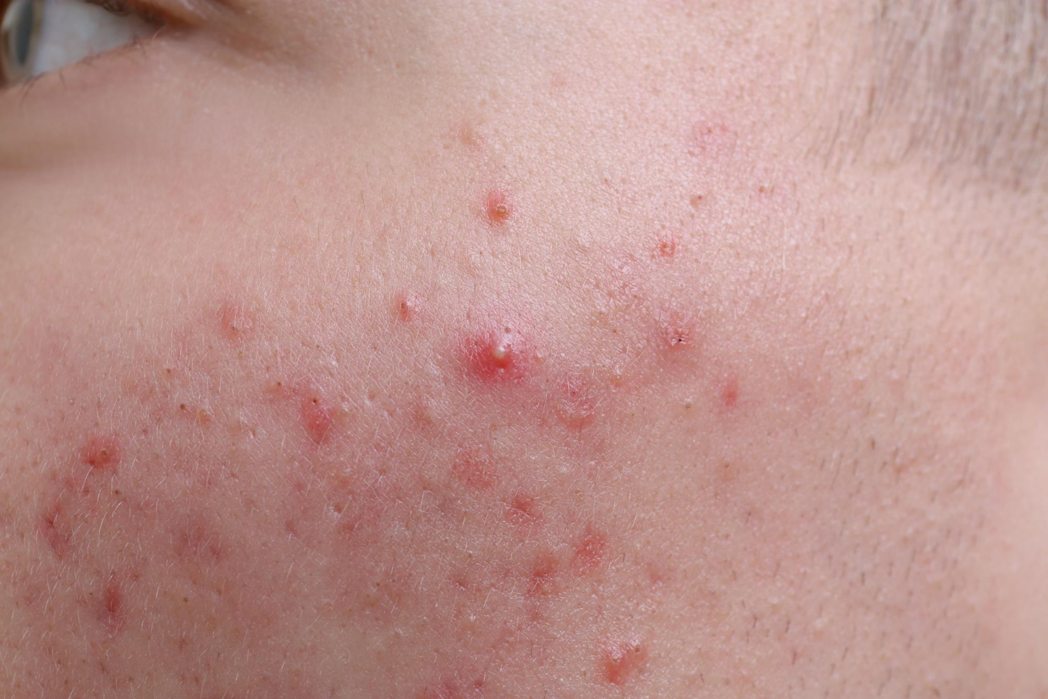 Jerawat Hormonal Dewasa: Kenapa Susah Hilang & Solusi Medisnya